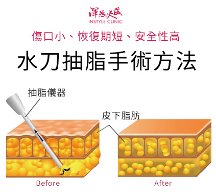渾然天成整形醫美|水刀抽脂,傷口小、出血量少、安全性高。 渾然天成整形醫美|水刀抽脂,傷口小、出血量少、安全性高。